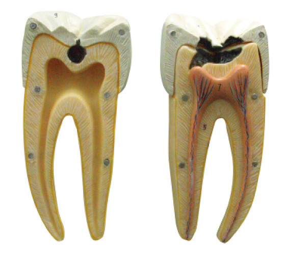 In Initial And Advanced Stages Of Dental Caries Model For Learning And Training